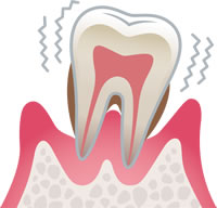 歯周病とは何か